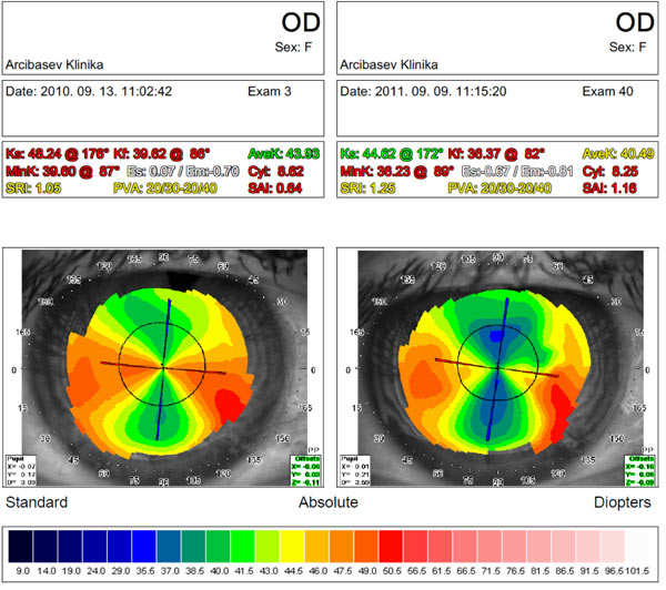 Results of diamond surgery for keratoconus after corneal transplant